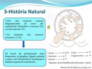 3-História Natural
• 70%     dos      tumores     vesicais
diagnosticados      de    novo     são
superficiais (limitados à mucosa (Ta)
ou sub-mucosa (T1).

• Os     restantes    são     tumores
invasivos, (≥ T2).




Os locais de metastização mais
frequentes: os gânglios, fígado, pulmão
e ossos. 50% desenvolvem metástases à
distância apesar de tratamento.           Esquema de la Estadificación del tumor vesical

                                                       Manual CTO de Medicina y Cirugía, 2011
 