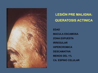 LESIÓN PRE MALIGNA:
QUERATOSIS ACTINICA
EDAD
MACULA ESCAMOSA
ZONA EXPUESTA
IRREGULAR
HIPERCROMICA
DESCAMATIVA
MENOS DEL 1%
CA. ESPINO CELULAR
 