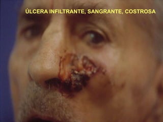 ÚLCERA INFILTRANTE, SANGRANTE, COSTROSA
 