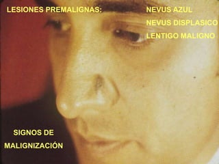 SIGNOS DE
MALIGNIZACIÓN
LESIONES PREMALIGNAS: NEVUS AZUL
NEVUS DISPLASICO
LENTIGO MALIGNO
 
