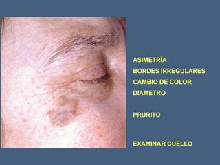 ASIMETRÍA
BORDES IRREGULARES
CAMBIO DE COLOR
DIAMETRO
PRURITO
EXAMINAR CUELLO
 