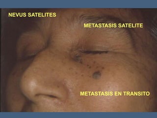 NEVUS SATELITES
METASTASIS SATELITE
METASTASIS EN TRANSITO
 