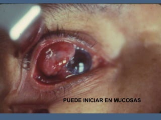 PUEDE INICIAR EN MUCOSAS
 