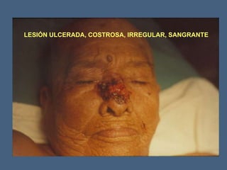 LESIÓN ULCERADA, COSTROSA, IRREGULAR, SANGRANTE
 
