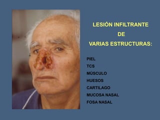 LESIÓN INFILTRANTE
DE
VARIAS ESTRUCTURAS:
PIEL
TCS
MÚSCULO
HUESOS
CARTILAGO
MUCOSA NASAL
FOSA NASAL
 