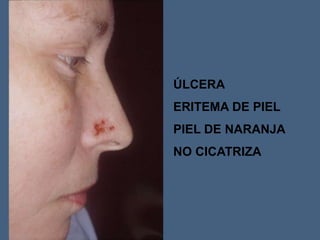ÚLCERA
ERITEMA DE PIEL
PIEL DE NARANJA
NO CICATRIZA
 