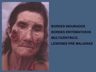 BORDES INDURADOS
BORDES ERITEMATOSOS
MULTICÉNTRICO.
LESIONES PRE MALIGNAS
 