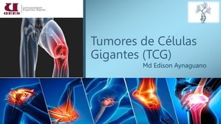 Tumores de Células
Gigantes (TCG)
Md Edison Aynaguano
 