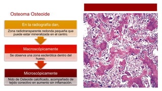 Osteoma Osteoide
Nido de Osteoide calcificado, acompañado de
tejido conectivo en aumento sin inflamación.
Se observa una zona esclerótica dentro del
hueso.
Zona radiotransparente redonda pequeña que
puede estar mineralizada en el centro.
 