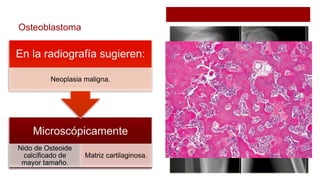 Osteoblastoma
Nido de Osteoide
calcificado de
mayor tamaño.
Matriz cartilaginosa.
Neoplasia maligna.
 