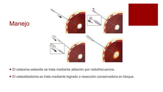 Manejo
 El osteoma osteoide se trata mediante ablación por radiofrecuencia.
 El osteoblastoma se trata mediante legrado o resección conservadora en bloque.
 