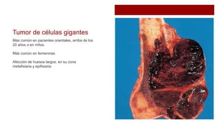 Tumor de células gigantes
Más común en pacientes orientales, arriba de los
20 años o en niños.
Más común en femeninas.
Afección de huesos largos, en su zona
metafisiaria y epifisiaria.
 