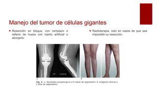 Manejo del tumor de células gigantes
 Radioterapia, solo en casos de que sea
imposible su resección.
 Resección en bloque, con remplazo o
relleno de hueso con injerto artificial o
aloinjerto.
 