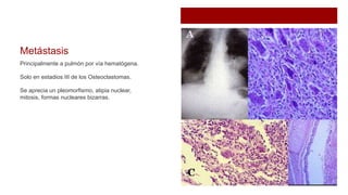 Metástasis
Principalmente a pulmón por vía hematógena.
Solo en estadios III de los Osteoclastomas.
Se aprecia un pleomorfismo, atipia nuclear,
mitosis, formas nucleares bizarras.
 