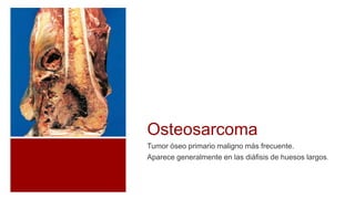 Osteosarcoma
Tumor óseo primario maligno más frecuente.
Aparece generalmente en las diáfisis de huesos largos.
 