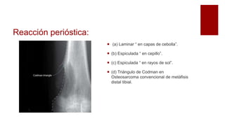 Reacción perióstica:
 (a) Laminar “ en capas de cebolla”.
 (b) Espiculada “ en cepillo”.
 (c) Espiculada “ en rayos de sol”.
 (d) Triángulo de Codman en
Osteosarcoma convencional de metáfisis
distal tibial.
 
