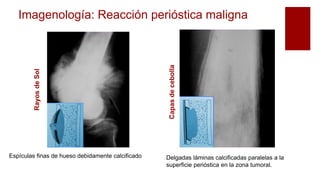 Imagenología: Reacción perióstica maligna
RayosdeSol
Capasdecebolla
Espículas finas de hueso debidamente calcificado Delgadas láminas calcificadas paralelas a la
superficie perióstica en la zona tumoral.
 