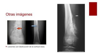 Otras imágenes
 Lesiones con destrucción de la cortical ósea.
 