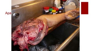 Apariencia macroscópica
 Dependerá de la celularidad y tipo.
 Puede presentarse como hueso
aparentemente normal intramedular,
quístico, hemorrágico.
 Destrucción de la corteza y elevación del
periostio.
 Extender a tejidos blandos hasta ulcerar
piel o articulaciones.
 