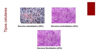 Sarcoma osteoblástico (50%) Sarcoma condroblástico (25%)
Sarcoma fibroblástico (25%)
Tiposcelulares
 