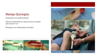 Manejo Quirúrgico
Amputación con desarticulación.
Salvar la extremidad en casos de que el margen
sea más de 5 cm.
Remplazo con endoprotesis tumorales
 