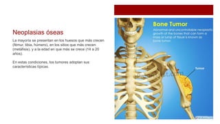 Neoplasias óseas
La mayoría se presentan en los huesos que más crecen
(fémur, tibia, húmero), en los sitios que más crecen
(metáfisis), y a la edad en que más se crece (14 a 20
años).
En estas condiciones, los tumores adoptan sus
características típicas.
 