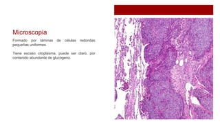 Microscopia
Formado por láminas de células redondas
pequeñas uniformes.
Tiene escaso citoplasma, puede ser claro, por
contenido abundante de glucógeno.
 