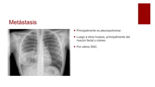 Metástasis
 Principalmente es pleuropulmonar.
 Luego a otros huesos, principalmente del
macizo facial y cráneo.
 Por ultimo SNC.
 
