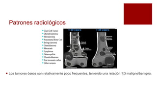 Patrones radiológicos
 Los tumores óseos son relativamente poco frecuentes, teniendo una relación 1:3 maligno/benigno.
 
