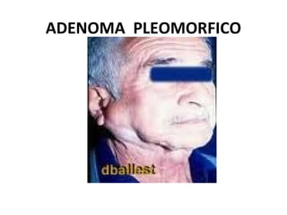 ADENOMA PLEOMORFICO
 