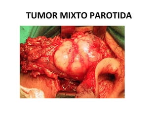 TUMOR MIXTO PAROTIDA
 