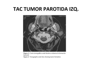 TAC TUMOR PAROTIDA IZQ.
 