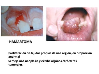 Proliferación de tejidos propios de una región, en proporciónProliferación de tejidos propios de una región, en proporción
anormalanormal
Semeja una neoplasia y exhibe algunos caracteresSemeja una neoplasia y exhibe algunos caracteres
tumorales.tumorales.
HAMARTOMA
 