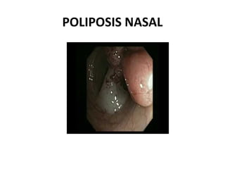 POLIPOSIS NASAL
 