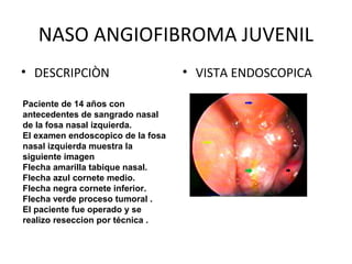 NASO ANGIOFIBROMA JUVENIL
• DESCRIPCIÒN • VISTA ENDOSCOPICA
Paciente de 14 años con
antecedentes de sangrado nasal
de la fosa nasal izquierda.
El examen endoscopico de la fosa
nasal izquierda muestra la
siguiente imagen
Flecha amarilla tabique nasal.
Flecha azul cornete medio.
Flecha negra cornete inferior.
Flecha verde proceso tumoral .
El paciente fue operado y se
realizo reseccion por técnica .
 