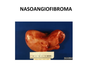 NASOANGIOFIBROMA
 