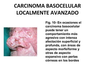 CARCINOMA BASOCELULAR
LOCALMENTE AVANZADO
Fig. 10- En ocasiones el
carcinoma basocelular
puede tener un
comportamiento más
agresivo con intensa
afectación superficial y
profunda, con áreas de
aspecto morfeiforme y
otras de aspecto
expansivo con perlas
córneas en los bordes
 