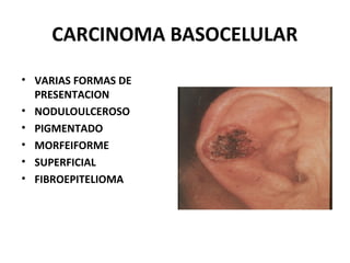 CARCINOMA BASOCELULAR
• VARIAS FORMAS DE
PRESENTACION
• NODULOULCEROSO
• PIGMENTADO
• MORFEIFORME
• SUPERFICIAL
• FIBROEPITELIOMA
 