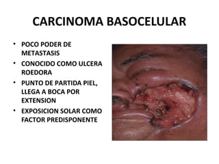 CARCINOMA BASOCELULAR
• POCO PODER DE
METASTASIS
• CONOCIDO COMO ULCERA
ROEDORA
• PUNTO DE PARTIDA PIEL,
LLEGA A BOCA POR
EXTENSION
• EXPOSICION SOLAR COMO
FACTOR PREDISPONENTE
 