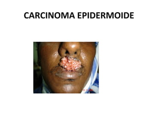 CARCINOMA EPIDERMOIDE
 