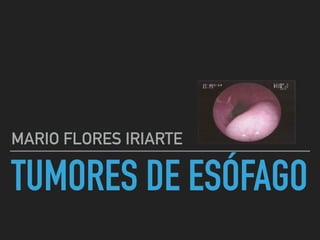 TUMORES DE ESÓFAGO
MARIO FLORES IRIARTE
 