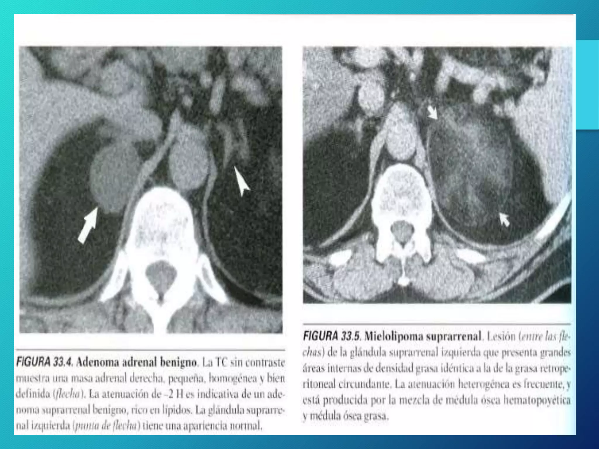 Tumores De La Glandula Suprarrenal Diagn stico Imagenol gico PPTX Tumores De La Glandula Suprarrenal Diagn stico Imagenol gico PPTX