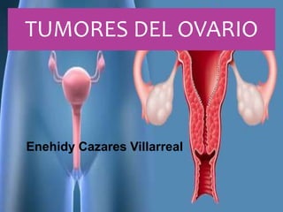 Enehidy Cazares Villarreal
TUMORES DEL OVARIO
 