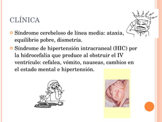 CLÍNICA  Síndrome cerebeloso de línea media: ataxia, equilibrio pobre, dismetría. Síndrome de hipertensión intracraneal (HIC) por la hidrocefalia que produce al obstruir el IV ventrículo: cefalea, vómito, nauseas, cambios en el estado mental e hipertensión. 