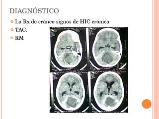 DIAGNÓSTICO La Rx de cráneo signos de HIC crónica TAC. RM 