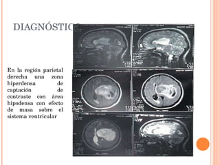 DIAGNÓSTICO En la región parietal derecha una zona hiperdensa de captación de contraste con área hipodensa con efecto de masa sobre el sistema ventricular 