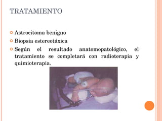 TRATAMIENTO Astrocitoma benigno Biopsia estereotáxica Según el resultado anatomopatológico, el tratamiento se completará con radioterapia y quimioterapia. 