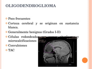 OLIGODENDROGLIOMA Poco frecuentes Corteza cerebral y se originan en sustancia blanca.  Generalmente benignos (Grados I-II) Células redondeadas con escaso citoplasma y microcalcificaciones Convulsiones TAC 