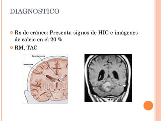 DIAGNOSTICO Rx de cráneo: Presenta signos de HIC e imágenes de calcio en el 20 %. RM, TAC 