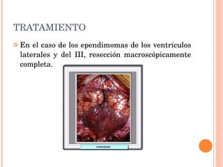 TRATAMIENTO En el caso de los ependimomas de los ventrículos laterales y del III, resección macroscópicamente completa.  